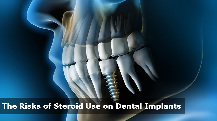 steroids and dental implants